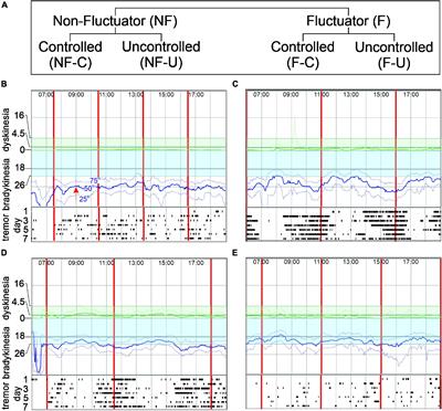 Sensor Measurements Can Characterize Fluctuations and Wearing Off in Parkinson’s Disease and Guide Therapy to Improve Motor, Non-motor and Quality of Life Scores